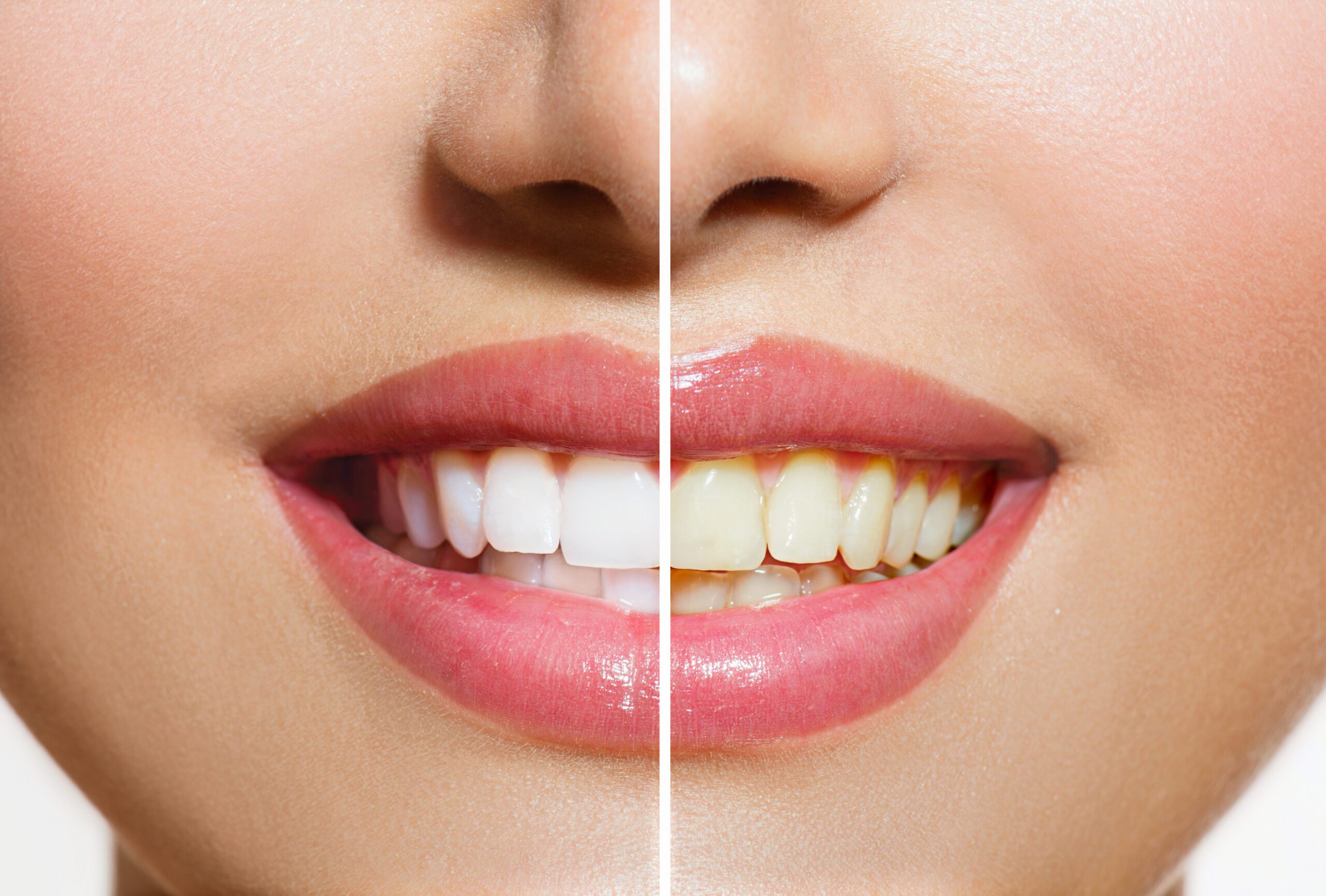 Woman Teeth Before and After Whitening. Oral Care Best Teeth Whitening Services in Toronto