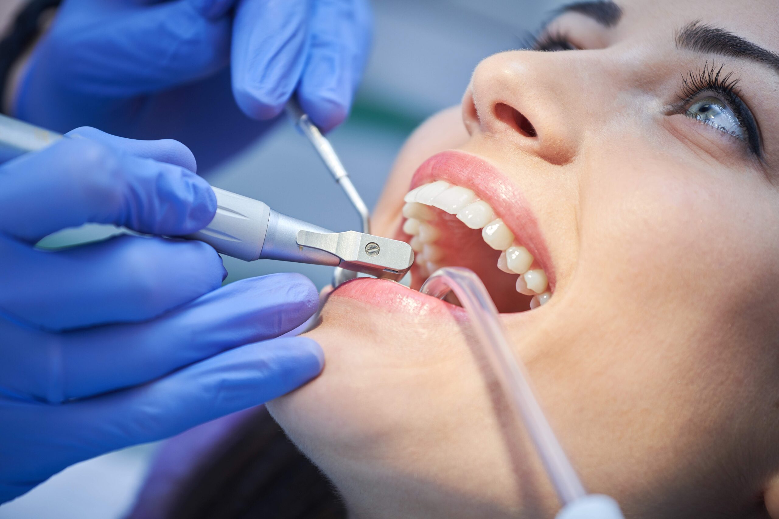 Best Dental Cleanings in Toronto