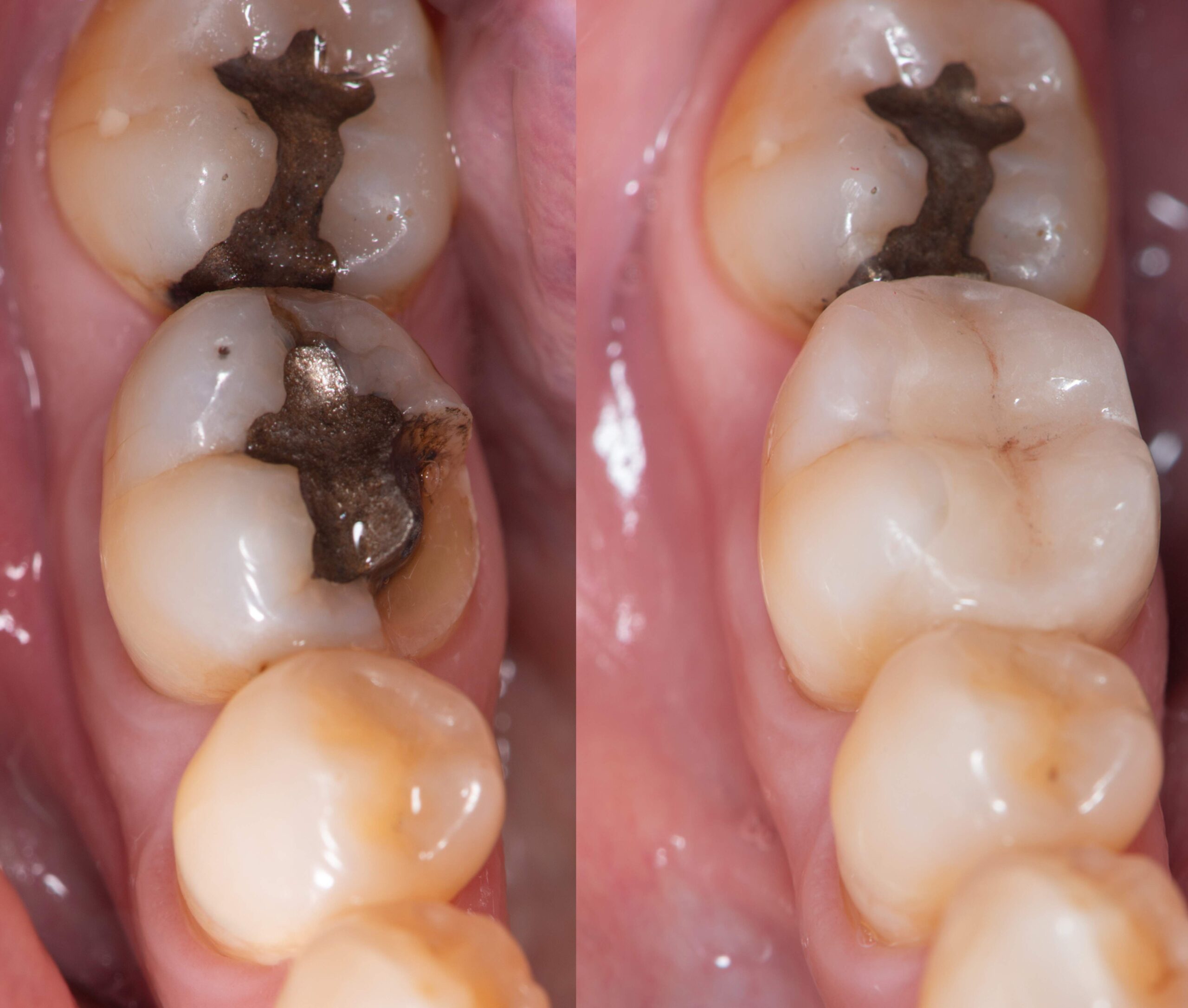 fillings (picture) Best Dental Fillings in Toronto