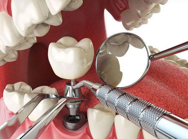 Dental implant crowns