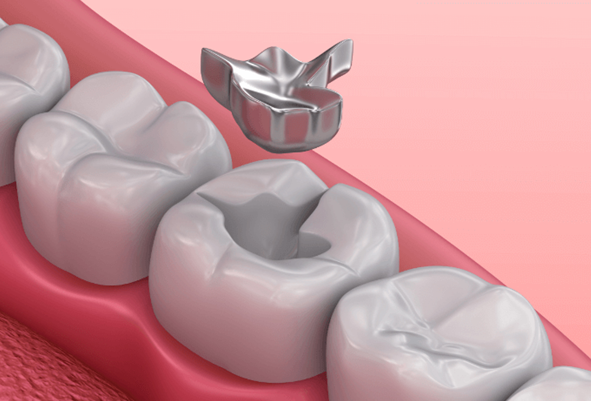 General Dentistry in One Yonge Street Toronto | One Yonge Dental Clinic Toronto