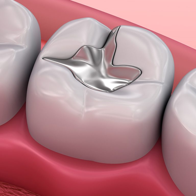 Dental_Blog_Image_Everything You Need to Know About Safe and Effective Dental Fillings