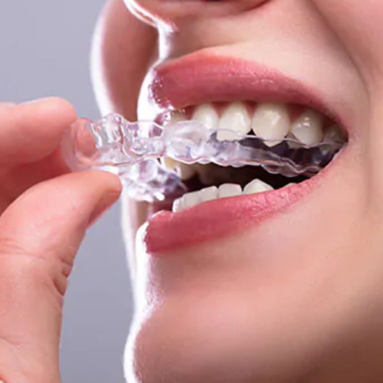 Dental_Blog_Image_Night Guards for Teeth Grinding