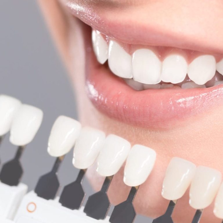 Dental_Blog_Image_Teeth Whitening Options In-Office vs. At-Home Treatments