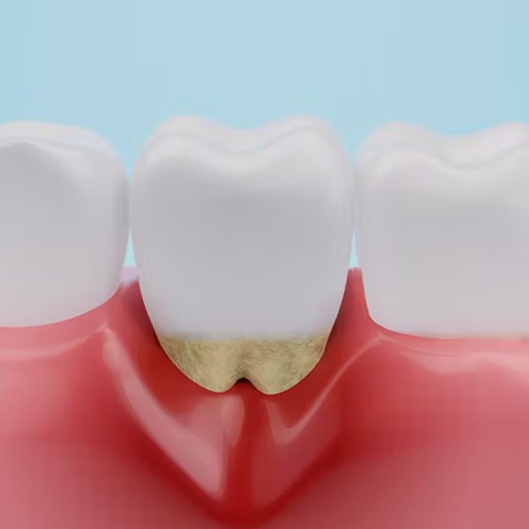 Dental_Blog_Image_The Impact of Gum Disease on Your Overall Health