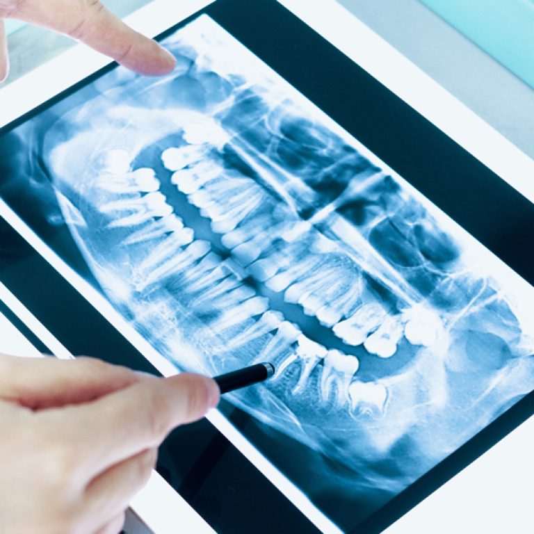 Dental_Blog_Image_Understanding the Importance of X-Rays in Dental Diagnostics